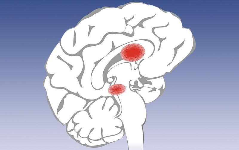 Grafik Eisenablagerungen im Gehirn